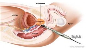 Realización de una ecografía transrectal de la próstata